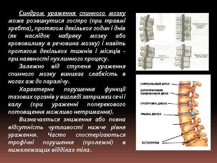 Синдром ураження спинного мозку може розвинутися гостро (при травмі хребта), протягом декількох годин і