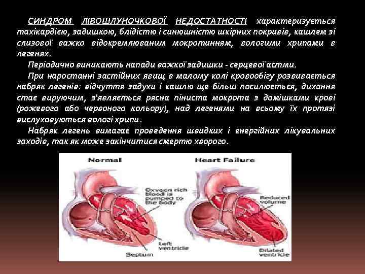 СИНДРОМ ЛІВОШЛУНОЧКОВОЇ НЕДОСТАТНОСТІ характеризується тахікардією, задишкою, блідістю і синюшністю шкірних покривів, кашлем зі слизової