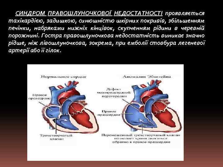СИНДРОМ ПРАВОШЛУНОЧКОВОЇ НЕДОСТАТНОСТІ проявляється тахікардією, задишкою, синюшністю шкірних покривів, збільшенням печінки, набряками нижніх кінцівок,