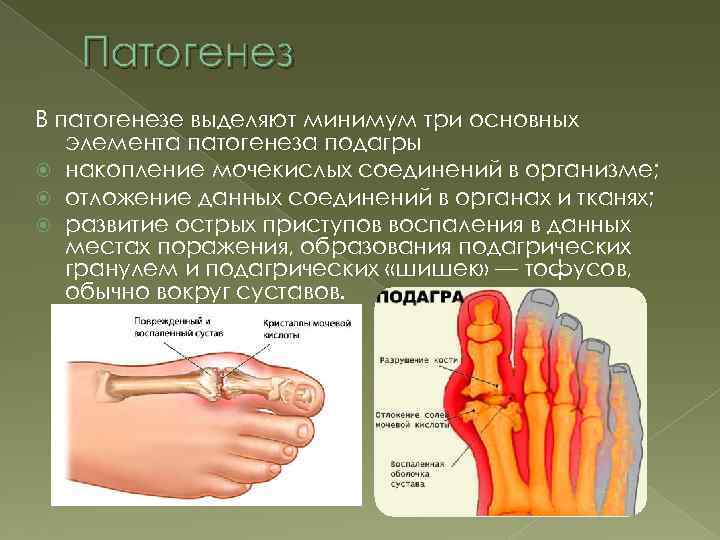 Патогенез В патогенезе выделяют минимум три основных элемента патогенеза подагры накопление мочекислых соединений в