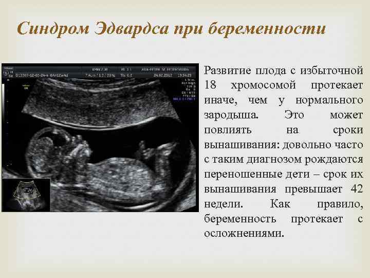 Синдром Эдвардса при беременности Развитие плода с избыточной 18 хромосомой протекает иначе, чем у