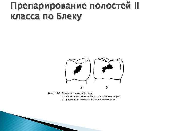 Препарирование полостей II класса по Блеку 