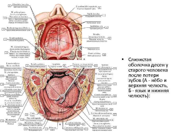  • Слизистая оболочка десен у старого человека после потери зубов (А - нёбо