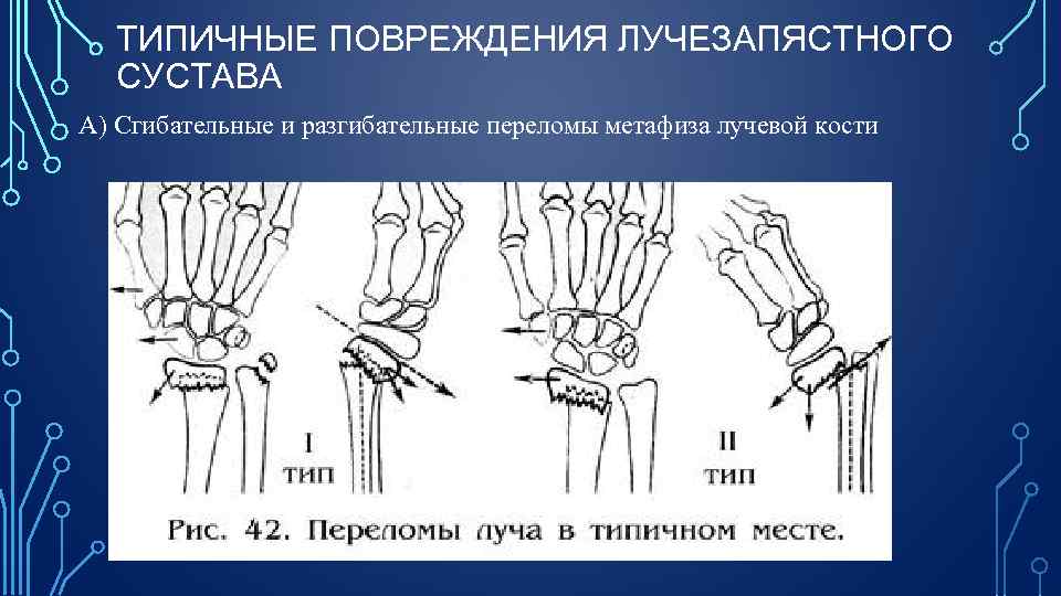 ТИПИЧНЫЕ ПОВРЕЖДЕНИЯ ЛУЧЕЗАПЯСТНОГО СУСТАВА А) Сгибательные и разгибательные переломы метафиза лучевой кости 