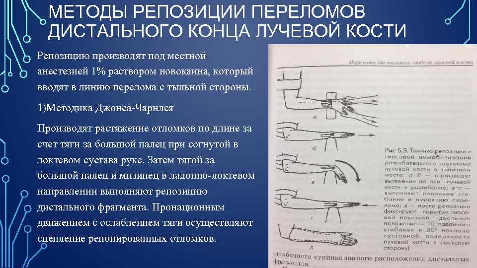 МЕТОДЫ РЕПОЗИЦИИ ПЕРЕЛОМОВ ДИСТАЛЬНОГО КОНЦА ЛУЧЕВОЙ КОСТИ Репозицию производят под местной анестезией 1% раствором