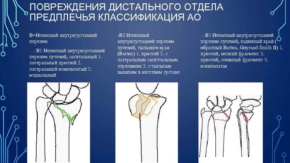 ПОВРЕЖДЕНИЯ ДИСТАЛЬНОГО ОТДЕЛА ПРЕДПЛЕЧЬЯ КЛАССИФИКАЦИЯ АО В=Неполный внутрисуставной перелом В 1 Неполный внутрисуставной перелом