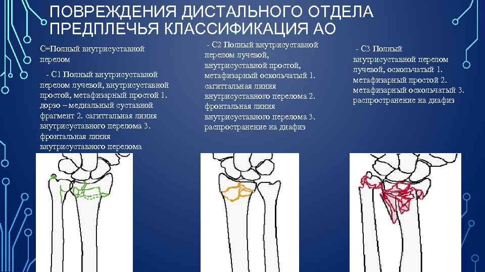 ПОВРЕЖДЕНИЯ ДИСТАЛЬНОГО ОТДЕЛА ПРЕДПЛЕЧЬЯ КЛАССИФИКАЦИЯ АО С=Полный внутрисуставной перелом С 1 Полный внутрисуставной перелом