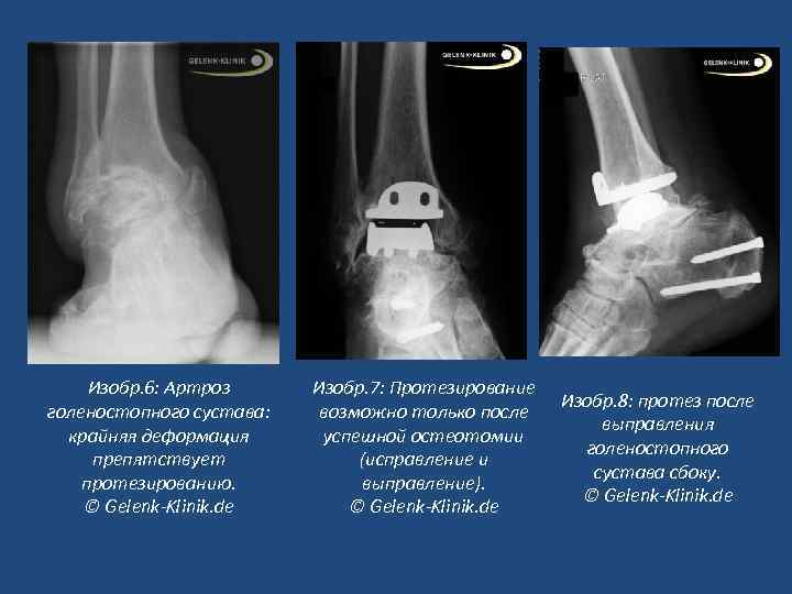 Изобр. 6: Артроз голеностопного сустава: крайняя деформация препятствует протезированию. © Gelenk-Klinik. de Изобр. 7: