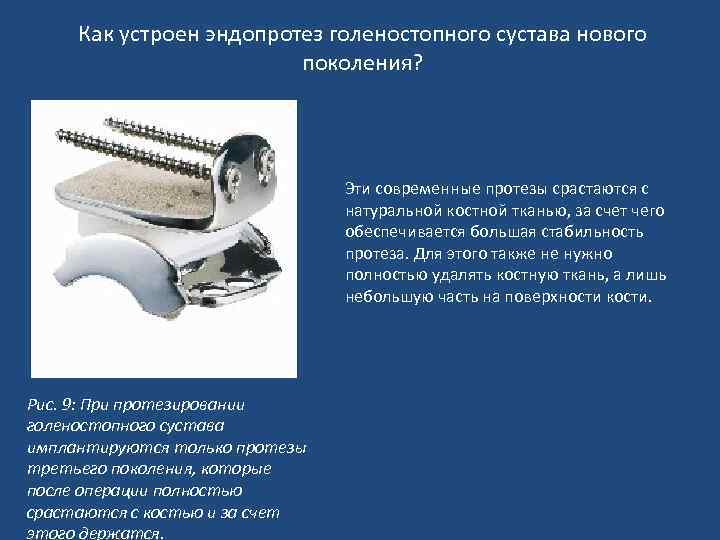 Как устроен эндопротез голеностопного сустава нового поколения? Эти современные протезы срастаются с натуральной костной