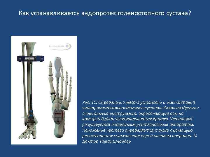 Как устанавливается эндопротез голеностопного сустава? Рис. 11: Определение места установки и имплантация эндопротеза голеностопного