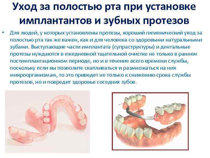 Уход за полостью рта при установке имплантантов и зубных протезов • Для людей, у