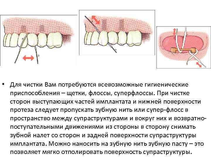  • Для чистки Вам потребуются всевозможные гигиенические приспособления – щетки, флоссы, суперфлоссы. При