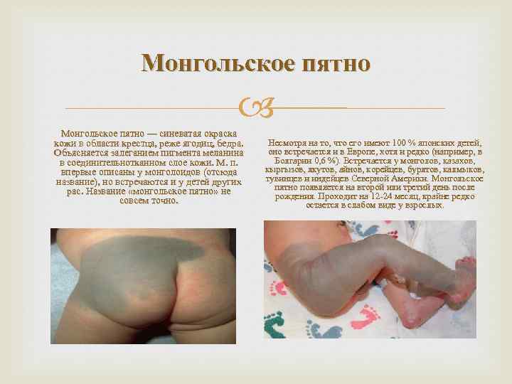 Монгольское пятно — синеватая окраска кожи в области крестца, реже ягодиц, бедра. Объясняется залеганием