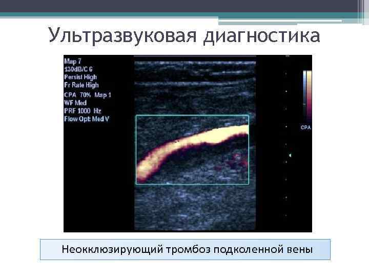 Ультразвуковая диагностика Неокклюзирующий тромбоз подколенной вены 