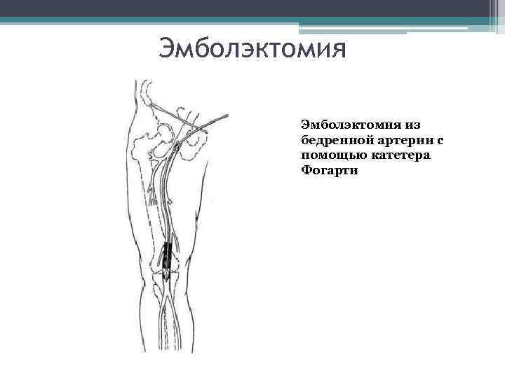 Эмболэктомия из бедренной артерии с помощью катетера Фогарти 