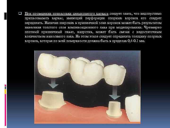 Временные коронки презентация