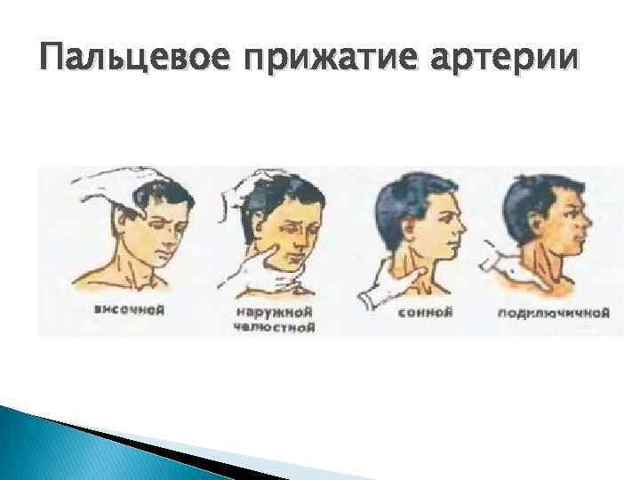 Пальцевое прижатие артерии 