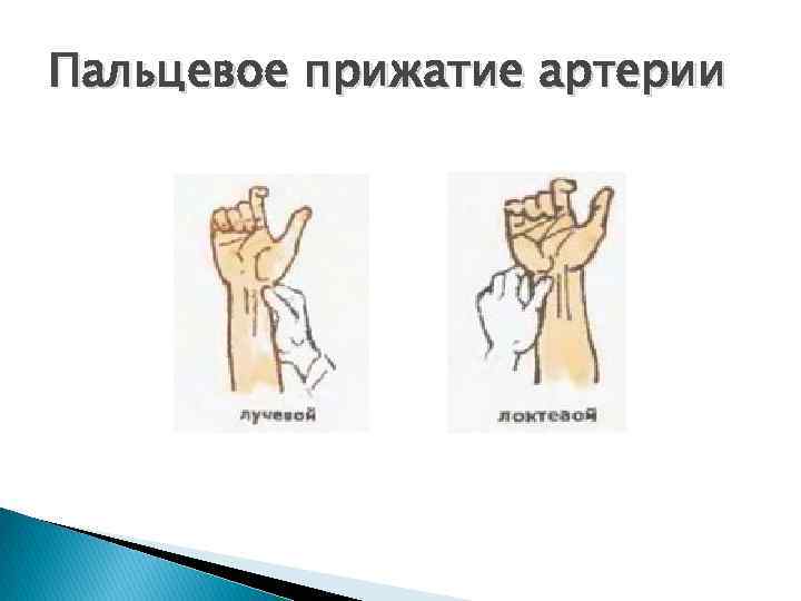 Пальцевое прижатие артерии 