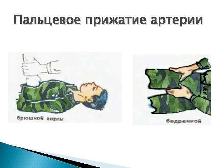 Пальцевое прижатие артерии 