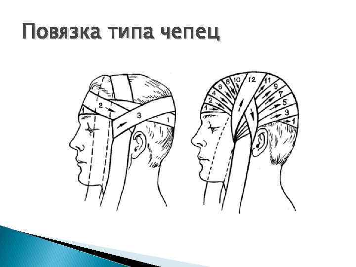 Повязка типа чепец 