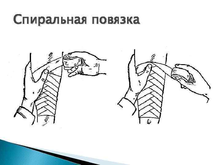 Спиральная повязка 