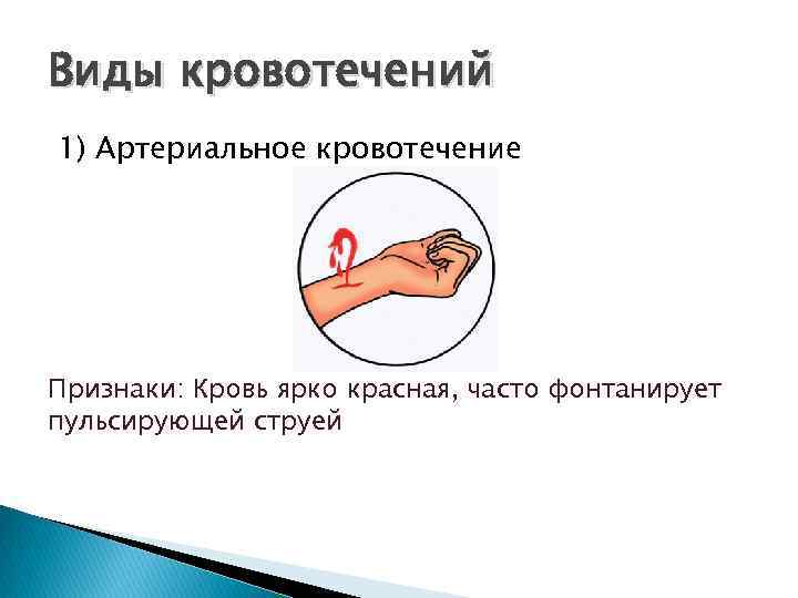 Виды кровотечений 1) Артериальное кровотечение Признаки: Кровь ярко красная, часто фонтанирует пульсирующей струей 