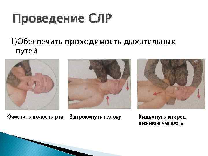 Проведение СЛР 1)Обеспечить проходимость дыхательных путей Очистить полость рта Запрокинуть голову Выдвинуть вперед нижнюю