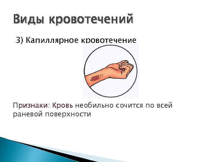 Виды кровотечений 3) Капиллярное кровотечение Признаки: Кровь необильно сочится по всей раневой поверхности 