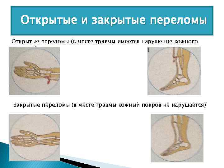 Открытые и закрытые переломы Открытые переломы (в месте травмы имеется нарушение кожного покрова) Закрытые