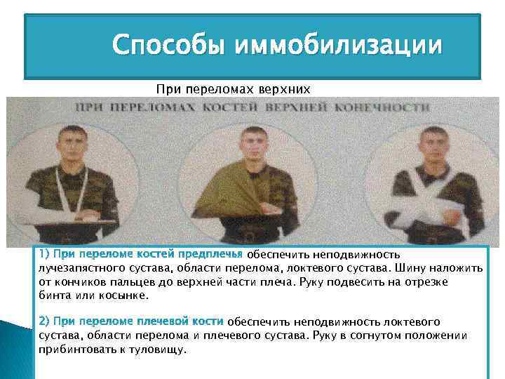 Способы иммобилизации конечностей При переломах верхних обеспечить неподвижность лучезапястного сустава, области перелома, локтевого сустава.