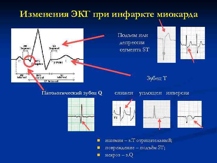 Изменения ЭКГ при инфаркте миокарда Подъем или депрессия сегмента ST Зубец T Патологический зубец