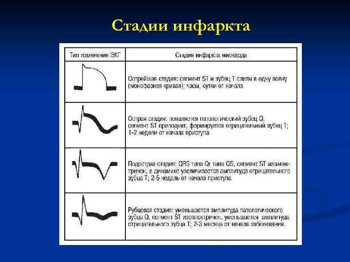 Стадии инфаркта 