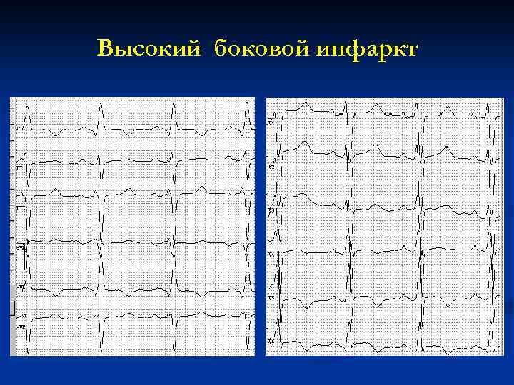 Высокий боковой инфаркт 