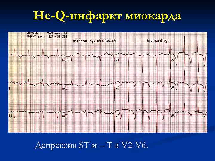 Не-Q-инфаркт миокарда Депрессия ST и – T в V 2 -V 6. 