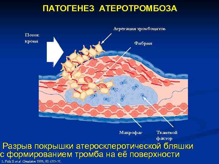 ПАТОГЕНЕЗ АТЕРОТРОМБОЗА Агрегация тромбоцитов Поток крови Фибрин Макрофаг Тканевой фактор Разрыв покрышки атеросклеротической бляшки