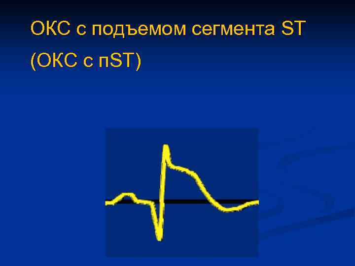 ОКС с подъемом сегмента ST (ОКС с п. ST) 