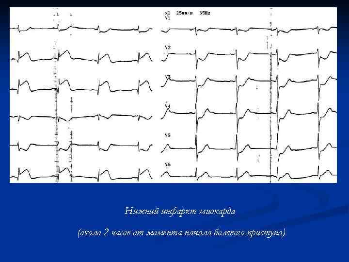 Нижний инфаркт миокарда (около 2 часов от момента начала болевого приступа) 