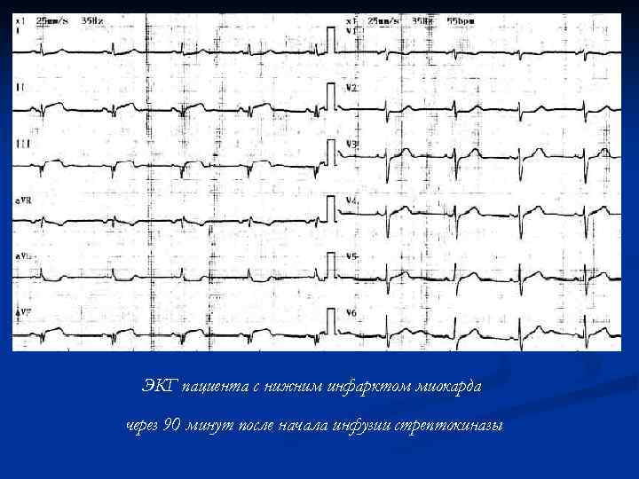 ЭКГ пациента с нижним инфарктом миокарда через 90 минут после начала инфузии стрептокиназы 