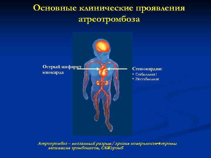 Основные клинические проявления атреотромбоза Острый инфаркт миокарда Стенокардия: • Стабильная ! • Нестабильная Атеротромбоз