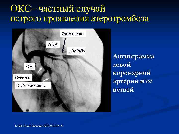 ОКС– частный случай острого проявления атеротромбоза Окклюзия ЛКА ПМЖВ ОА Стеноз Суб-окклюзия 1. Falk