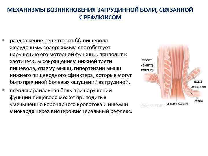 МЕХАНИЗМЫ ВОЗНИКНОВЕНИЯ ЗАГРУДИННОЙ БОЛИ, СВЯЗАННОЙ С РЕФЛЮКСОМ • раздражение рецепторов СО пищевода желудочным содержимым