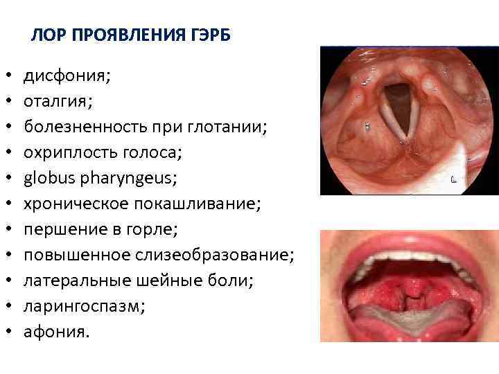 ЛОР ПРОЯВЛЕНИЯ ГЭРБ • • • дисфония; оталгия; болезненность при глотании; охриплость голоса; globus