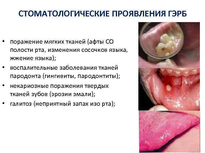 СТОМАТОЛОГИЧЕСКИЕ ПРОЯВЛЕНИЯ ГЭРБ • поражение мягких тканей (афты СО полости рта, изменения сосочков языка,