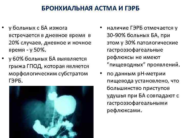 БРОНХИАЛЬНАЯ АСТМА И ГЭРБ • у больных с БА изжога встречается в дневное время