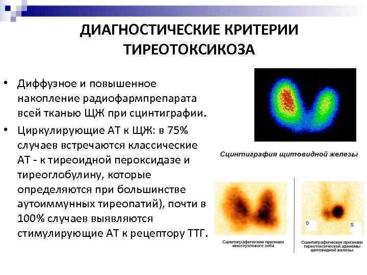 ДИАГНОСТИЧЕСКИЕ КРИТЕРИИ ТИРЕОТОКСИКОЗА • Диффузное и повышенное накопление радиофармпрепарата всей тканью ЩЖ при сцинтиграфии.