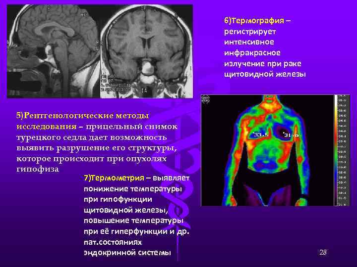 6)Термография – регистрирует интенсивное инфракрасное излучение при раке щитовидной железы 5)Рентгенологические методы исследования –