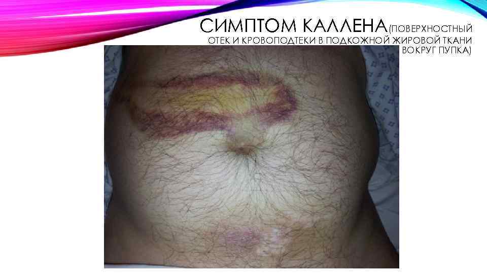 СИМПТОМ КАЛЛЕНА(ПОВЕРХНОСТНЫЙ ОТЕК И КРОВОПОДТЕКИ В ПОДКОЖНОЙ ЖИРОВОЙ ТКАНИ ВОКРУГ ПУПКА) 