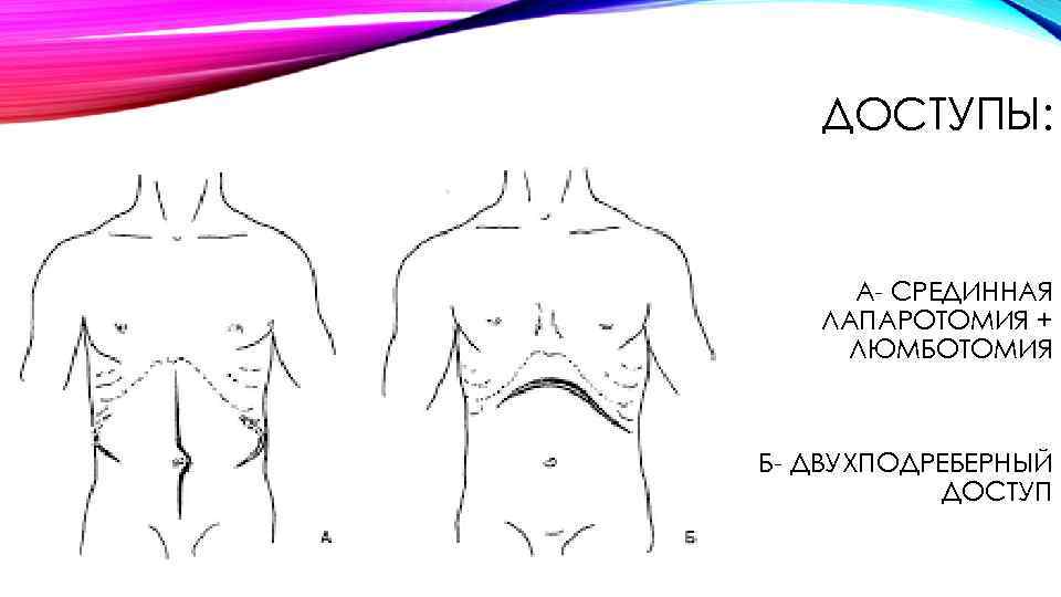 ДОСТУПЫ: А СРЕДИННАЯ ЛАПАРОТОМИЯ + ЛЮМБОТОМИЯ Б ДВУХПОДРЕБЕРНЫЙ ДОСТУП 
