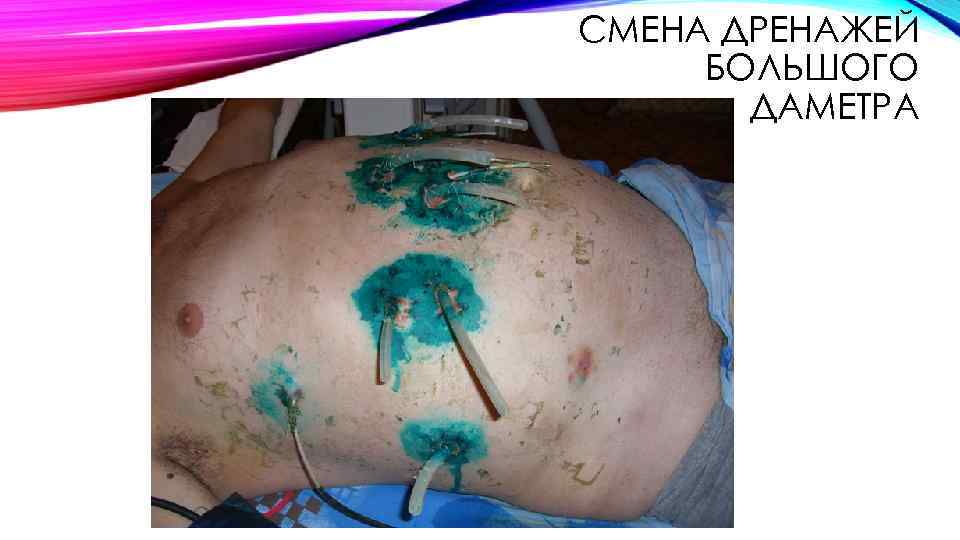 СМЕНА ДРЕНАЖЕЙ БОЛЬШОГО ДАМЕТРА 