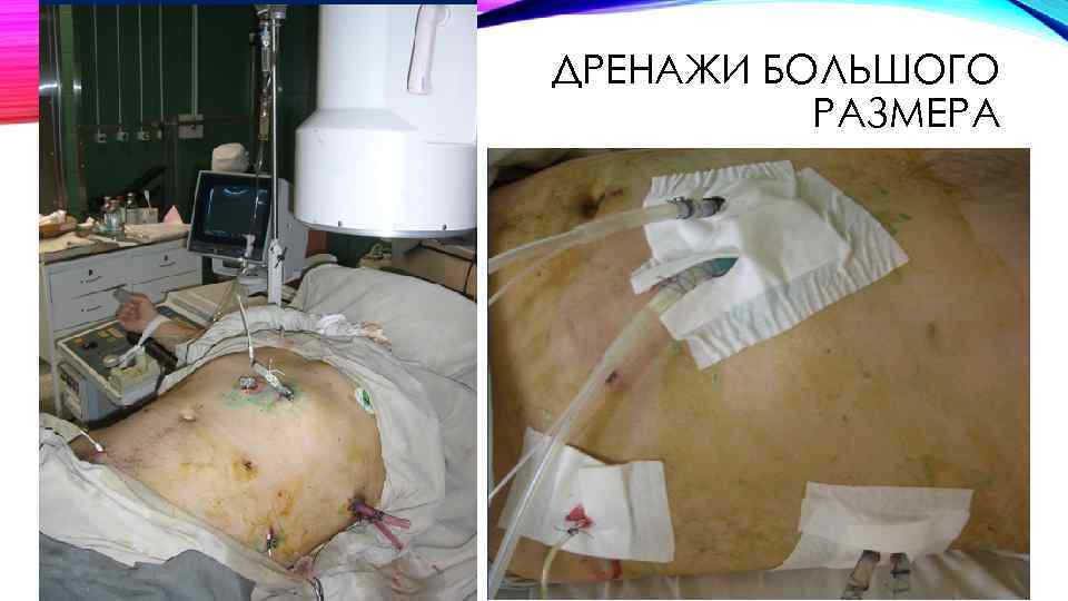 ДРЕНАЖИ БОЛЬШОГО РАЗМЕРА 